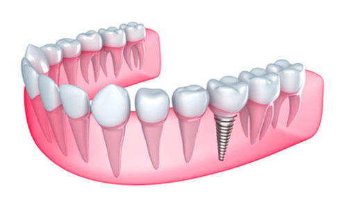 Image of jaw with single dental implant screw from Roy C. Blake III, DDS, MSD, Maxillofacial Prosthodontist in Jupiter, FL