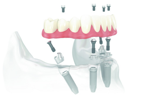  Diagram of All on 4 dental implants placed in a jaw