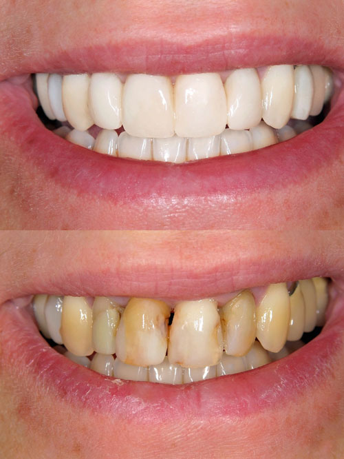 dental veneers for decay before and after